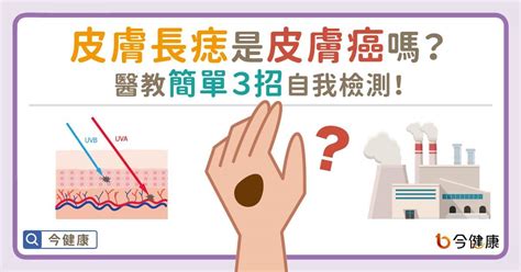 手臂長痣|皮膚長痣是皮膚癌嗎？常見症狀，簡單3招自我檢測｜ 